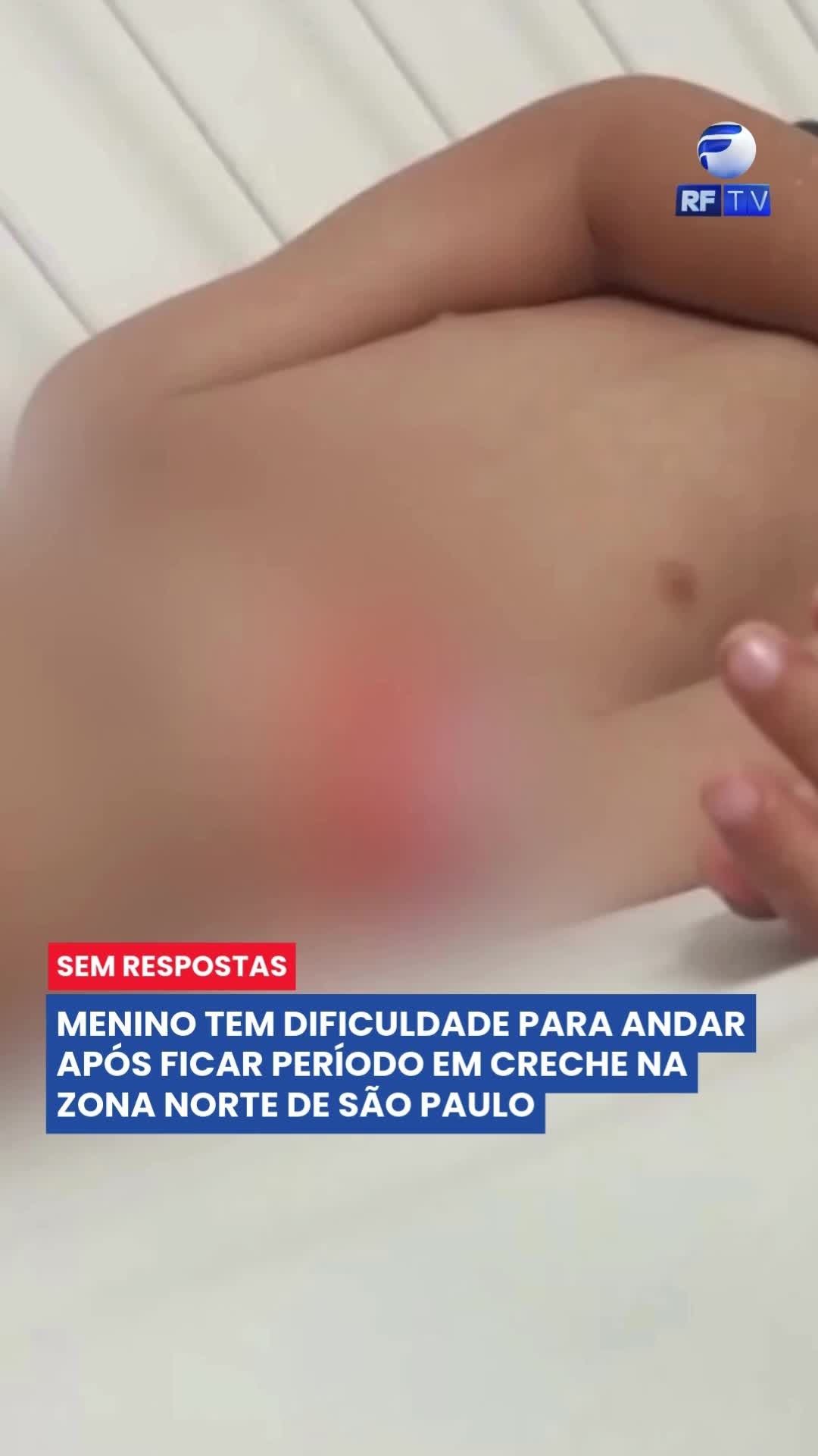 🚨 Alerta aos pais: Criança de 3 anos sofre lesão grave em creche na Zona Norte de SP
Um menino de apenas 3 anos foi deixado saudável por seus pais em uma creche na Zona Norte de São Paulo e, ao ser buscado, apresentava dificuldade para andar.
Segundo a família, a criança relatou ter caído de um brinquedo, o que coincidiu com o diagnóstico médico de derrame no quadril, provocado por uma pancada.
A diretoria regional de educação de Jaçanã e Tremembé afirmou que o menino estava brincando quando se queixou de dores, mas alegou que não há imagens do ocorrido devido a uma falha na câmera.
Os pais, Michelle e Davi, buscam esclarecimentos e pretendem lutar por justiça.
⚠️ Casos como esse reforçam a importância da segurança e da transparência nas instituições que cuidam de nossas crianças.
#Justiça #InfânciaSegura #Creche #ZonaNorteSP #DireitosDaCriança #SegurançaNasEscolas