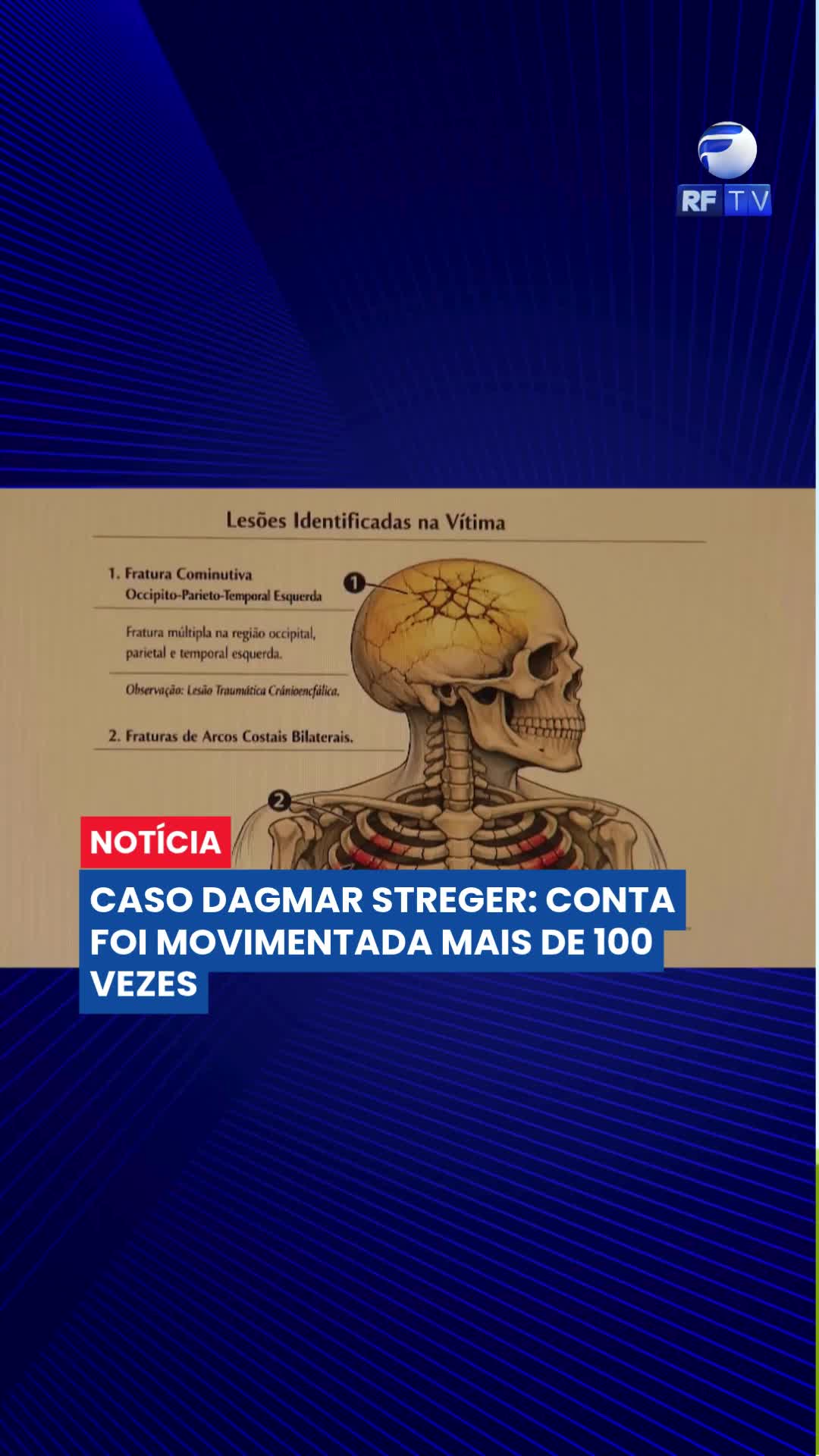 Idosa que acolheu caseiros é vítima de latrocínio e caso choca o interior de SP

Idosa que vivia sozinha e acolheu um casal de caseiros teve um fim trágico no interior de São Paulo. Dagmar desapareceu entre os dias 19 e 20 de dezembro de 2025, e desde então o caso mobilizou a polícia.

As suspeitas recaíram sobre o próprio casal que morava no local. Eles fugiram e foram encontrados no Paraná, em um posto de gasolina, tentando vender o carro da vítima. Presos, passaram a responder por latrocínio.

Durante as investigações, a polícia realizou buscas intensas no sítio, incluindo escavações em um poço desativado, além de apurar movimentações bancárias após o desaparecimento da idosa.

O corpo de Dagmar foi localizado apenas um mês depois, em 21 de janeiro de 2026. O caso chocou a região de Bauru pela violência e pela quebra de confiança — já que a vítima havia acolhido os suspeitos.

#Bauru #InteriorDeSP #PolíciaCivil #Investigação #Justiça #Segurança #CasoDagmar #Notícia #Brasil
