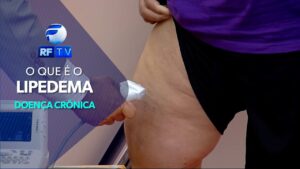 Lipedema: Doença vascular é confundida com celulite ou sobrepeso