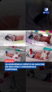 Uma gravidez considerada extremamente rara terminou com o nascimento de quatro meninas idênticas 😱👶
A australiana Jenitar Na’amoana, de 34 anos, deu à luz quadrigêmeas monozigóticas, quando um único óvulo fertilizado se divide em quatro embriões. Segundo os médicos, esse tipo de gestação acontece em cerca de uma a cada 15 milhões e foi classificado como de
altíssimo risco. As bebês nasceram prematuras, com 28 semanas de gestação, mas estão evoluindo bem na unidade neonatal.
Agora, a família acompanha a recuperação das recém-nascidas enquanto se prepara para uma nova rotina. O casal, que já tinha quatro filhos, iniciou uma campanha para arrecadar recursos e comprar um veículo maior para acomodar todos os integrantes da família.
Você já conhecia um caso tão raro como esse? 💬
#RFTV #PortalVeloz #Australia #Maternidade #Noticias